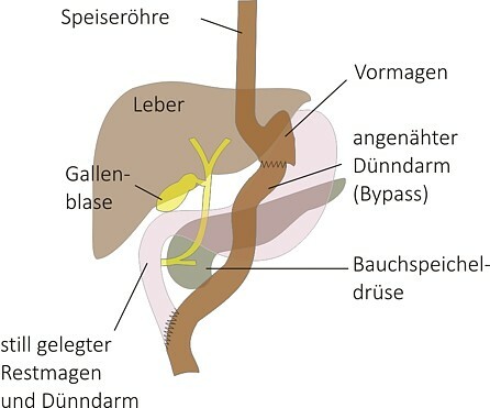 magenbypass